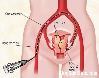 Nguyên nhân gây bệnh u xơ tử cung