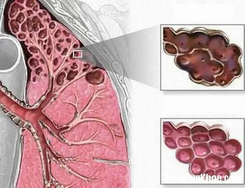 Những yếu tố gây bệnh khí phế thũng