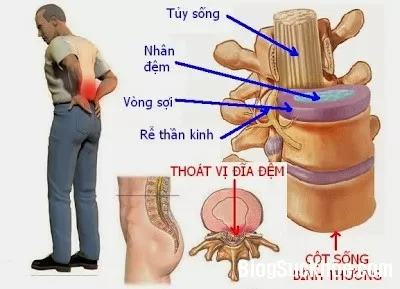Thoát vị đĩa đệm do đâu?
