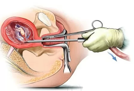 Những tai biến thường gặp sau nạo phá thai