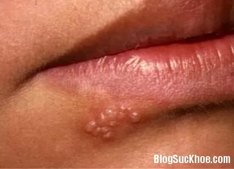 Các cây thuốc hay chữa bệnh giời leo