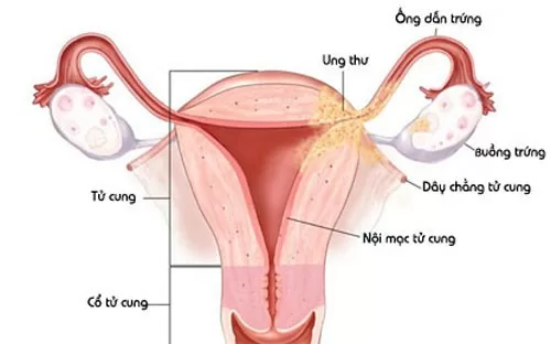 5 nguyên nhân xuất hiện cục máu đông ngày "đèn đỏ"
