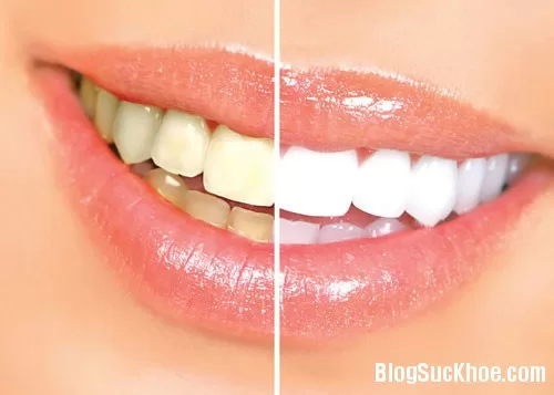 Những thắc mắc quanh chuyện răng bị ố vàng