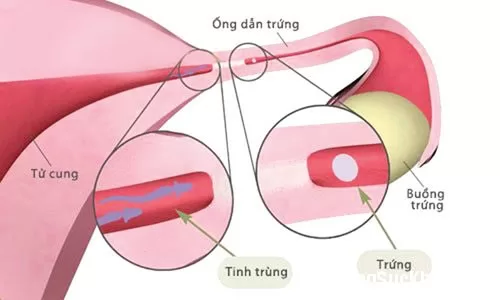 Tắc vòi trứng, nguyên nhân gây khả năng vô sinh