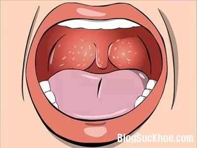Cách phòng ngừa viêm amiđan
