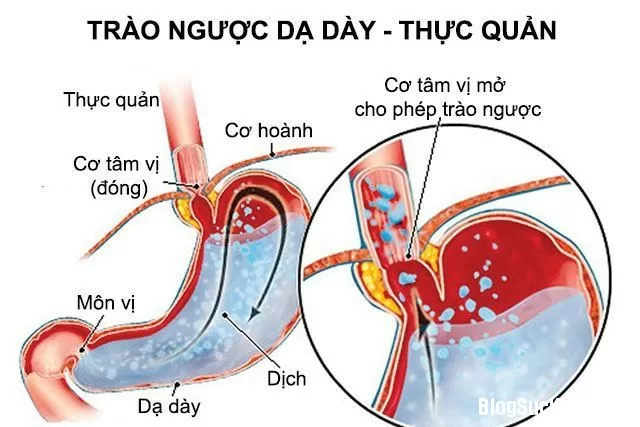 Khắc phục bệnh trào ngược dạ dày thực quản