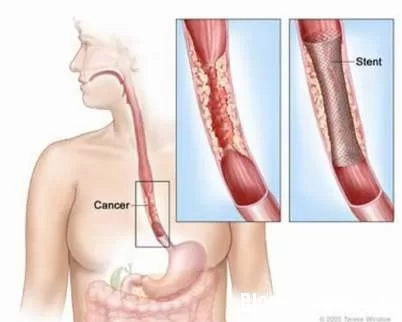 Triệu chứng và biến chứng bệnh ung thư thực quản