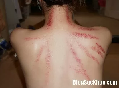 Cạo gió trong những trường hợp nào?