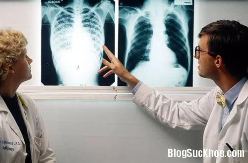 Triệu chứng cảnh báo bệnh lao phổi