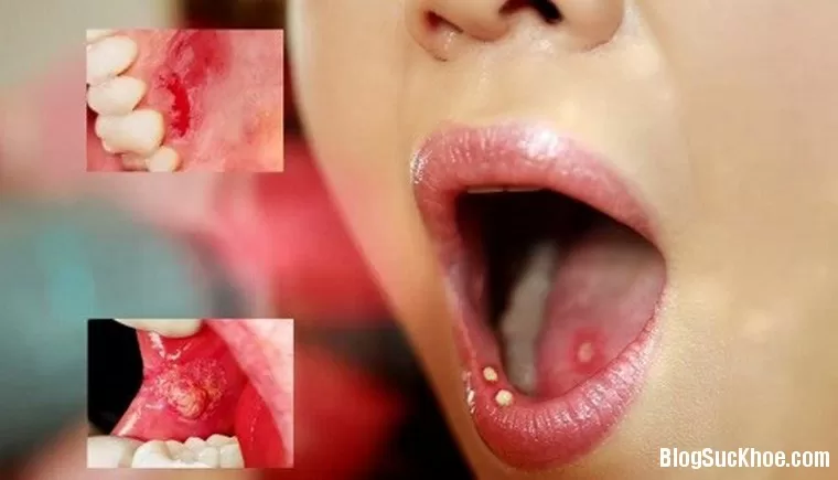 Biểu hiện không ngờ của bệnh ung thư miệng