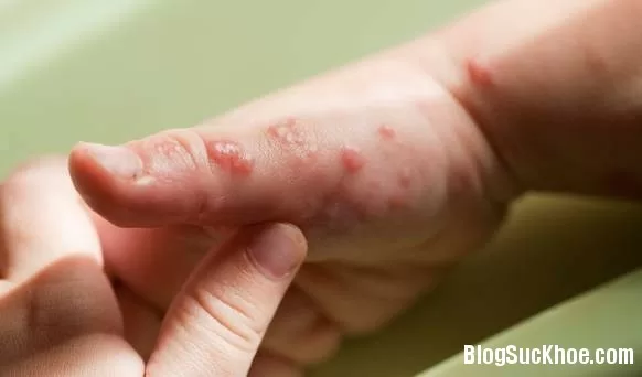 Mẹo trị vết bỏng do dầu ăn không để lại sẹo