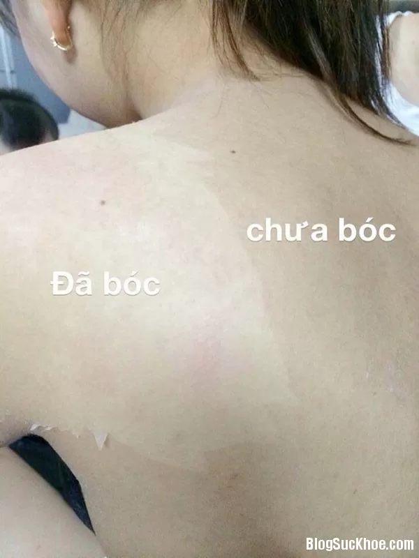 Hiểm họa khôn lường từ việc tắm trắng tại nhà