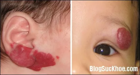 Bệnh u máu ở trẻ em