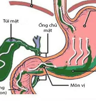 Nguyên nhân gây trào ngược dịch mật