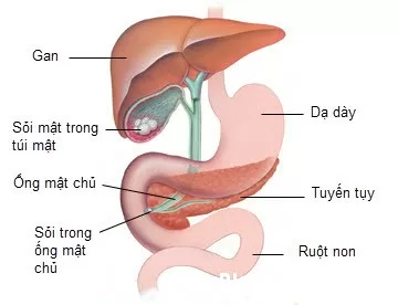 Xử trí kịp thời khi bị viêm tụy cấp