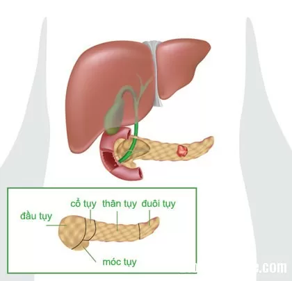 Nguyên nhân của ung thư tuyến tụy