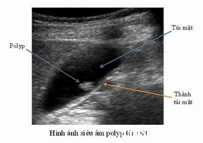 Triệu chứng bệnh Polyp túi mật