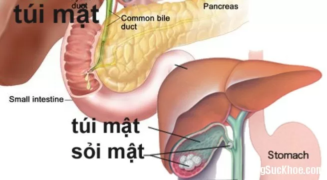 Bài thuốc dân gian chữa sỏi mật
