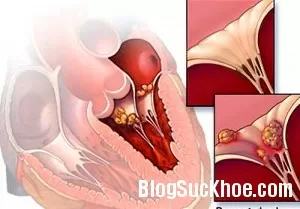 Bệnh thấp tim ở trẻ em có chữa được không?