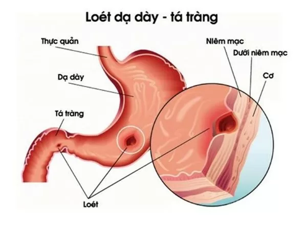 Phân biệt viêm loét dạ dày và viêm loét tá tràng