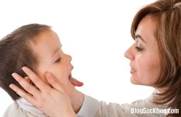 Chăm sóc và điều trị loét miệng cho bé