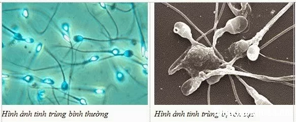 Điều trị tinh dịch vón cục