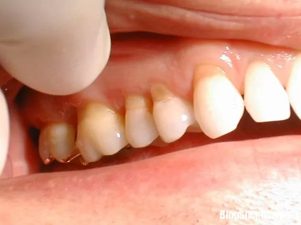 Nguyên nhân gây tụt lợi và cách phòng ngừa
