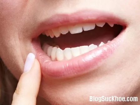 Cách điều trị bệnh viêm, lở miệng