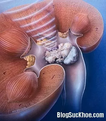 Nguy cơ và điều trị sỏi tiết niệu