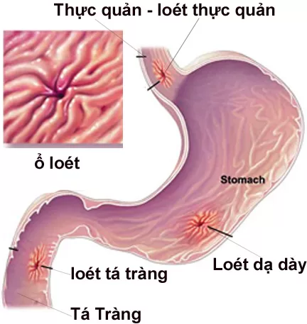 Nguyên nhân và triệu chứng bệnh viêm tá tràng
