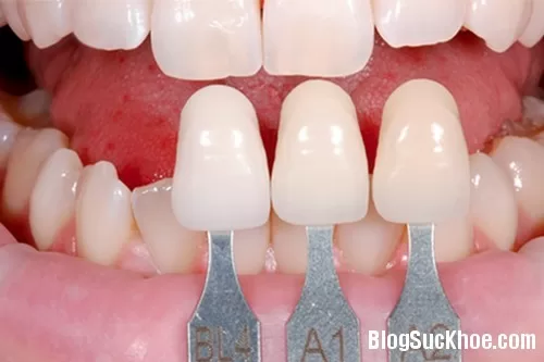 Những điều cần lưu ý khi làm răng giả