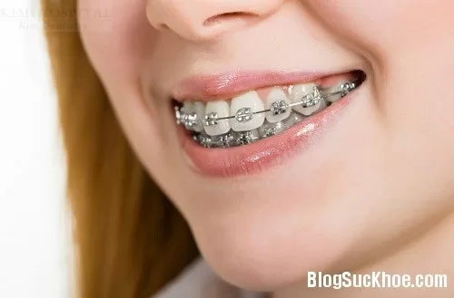 Cách chăm sóc răng trong và sau niềng răng
