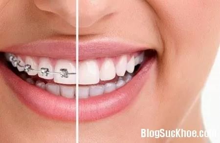 Những điều cần biết khi chỉnh nha