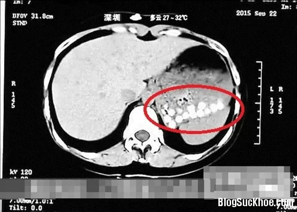 Kinh hãi trà sữa trân châu làm từ lốp xe cũ