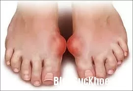 Bệnh gút và những điều cần biết