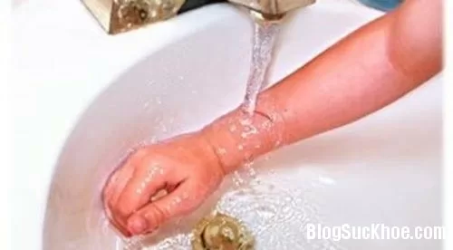 Cách sơ cứu khi con bị bỏng canh