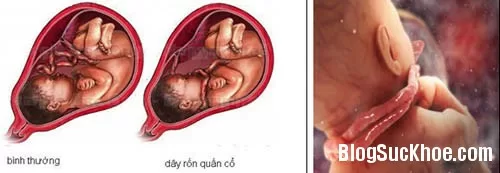 Cách phát hiện dây rốn quấn cổ thai nhi