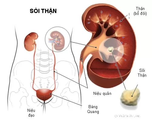 Đông y trị sỏi tiết niệu