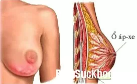 Biểu hiện và cách xử trí áp-xe vú