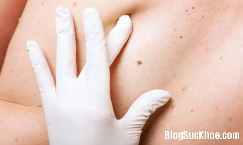 Dấu hiệu cảnh báo ung thư qua nốt ruồi