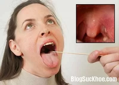 Bài thuốc chữa viêm họng hiệu quả