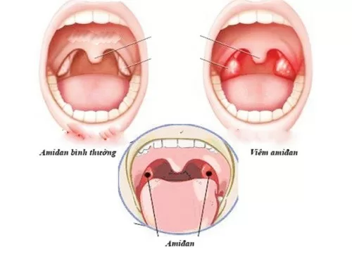 Các biểu hiện viêm amydal
