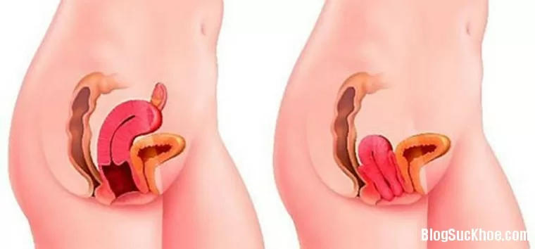 Co thắt âm đạo xử trí như thế nào?