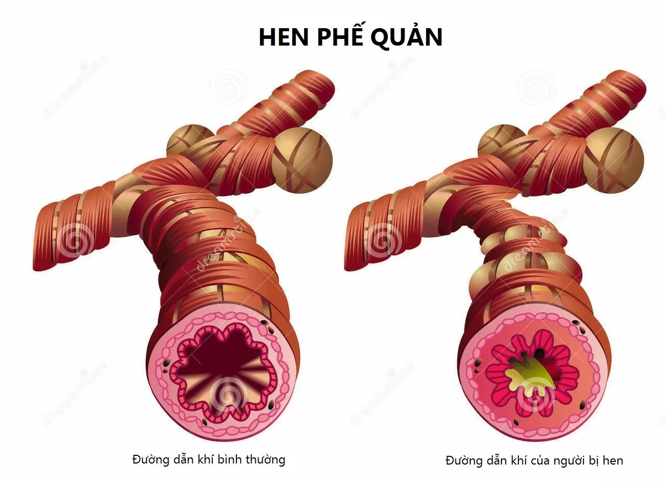 Cơ chế gây bệnh hen phế quản