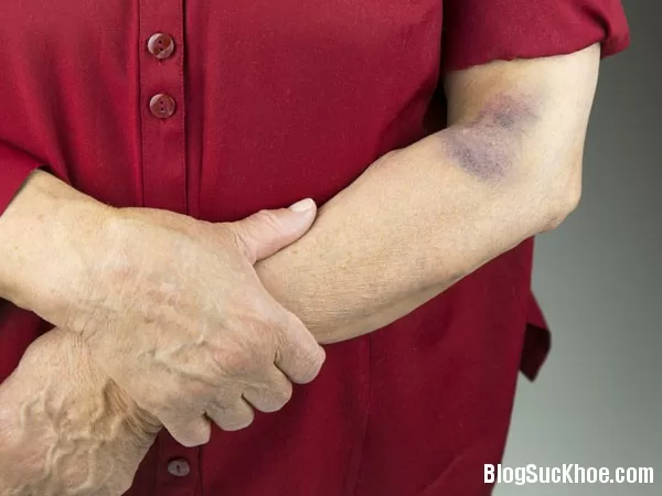 Những bệnh nguy hiểm liên quan đến vết bầm tím