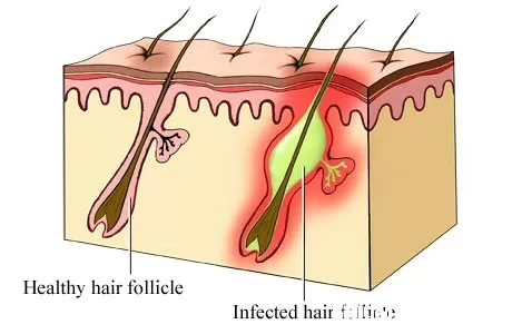 Biểu hiện và điều trị bệnh viêm nang lông