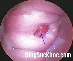 Chớ coi thường polyp cổ tử cung