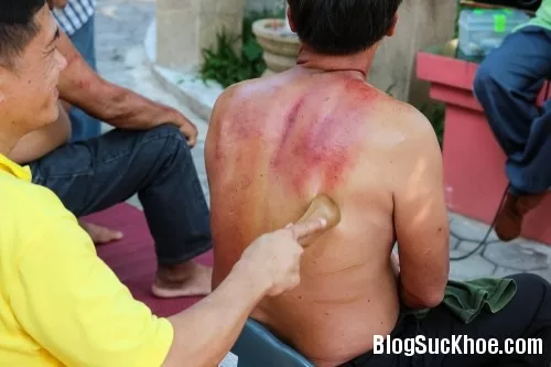 Cạo gió theo từng loại bệnh