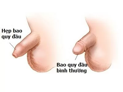 Điều trị hẹp quy đầu như thế nào?