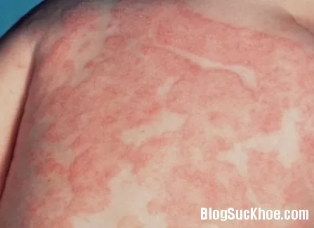 Đông y trị bệnh chàm